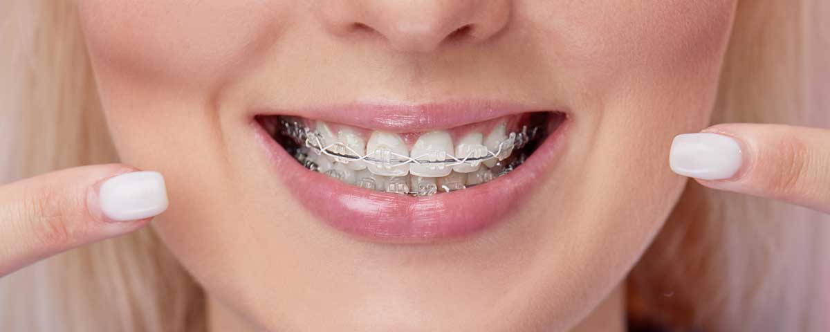 ¿Es mejor el tratamiento de ortodoncia con Brackets o alineadores?